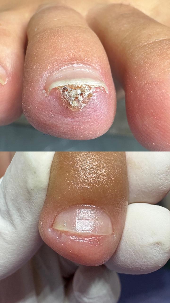 Tratamento de Verruga Plantar